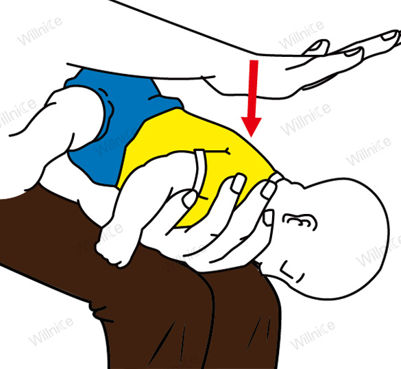 How to Hold Choking Infants for Back Blows [Full Guide]